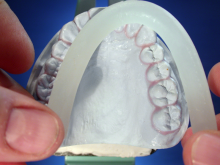primosplint - light cured composite in rod shape
