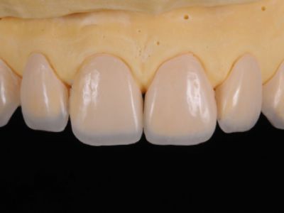 PREMIOtemp Multi - egg-shell veneers on the model