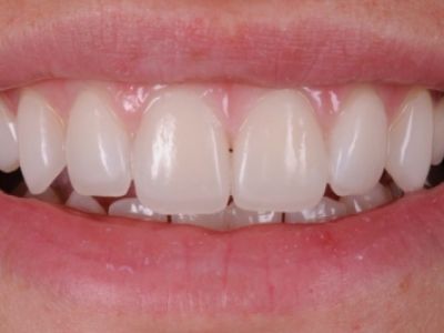 PREMIOtemp Multi - egg-shell veneers cemented