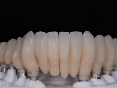 PREMIOtemp Multi - full lower arch temporary
