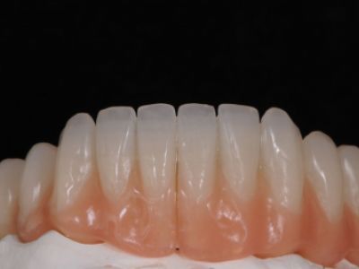 PREMIOtemp Multi - full lower arch temporary