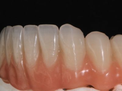 PREMIOtemp Multi - full lower arch temporary