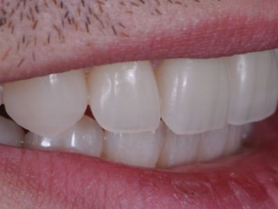 PREMIOtemp Multi - provisional crowns cemented