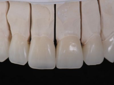 PREMIOtemp Multi - provisional crowns on the model