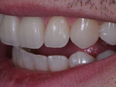 PREMIOtemp Multi - provisional crowns cemented
