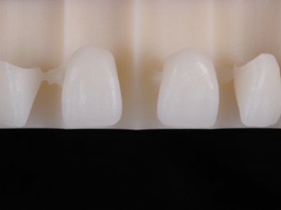 PREMIOtemp Multi - temporary crowns nested for maximum translucancy