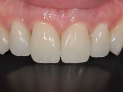 PREMIOtemp Multi - temporary crowns in situ