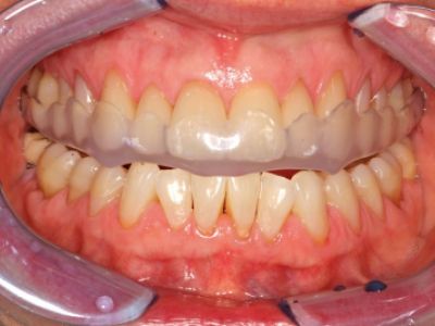 primosplint - bite splint in situ