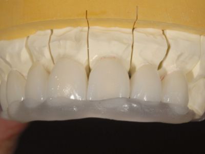 primosplint - insertion guide for veneers