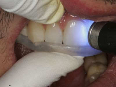 primosplint - bonding procedure