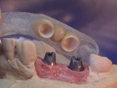 primosplint - transfer jig for crowns