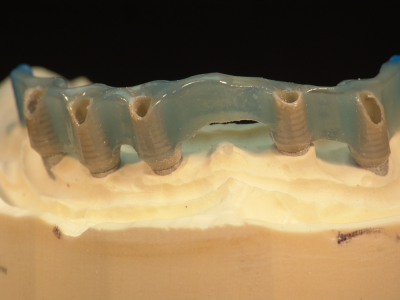 metablue - implant bar