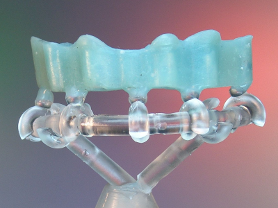 Implantatsteg