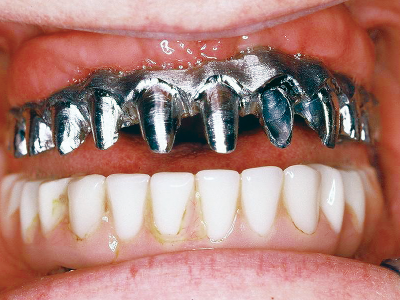 Implantatstruktur polymerisiert 
