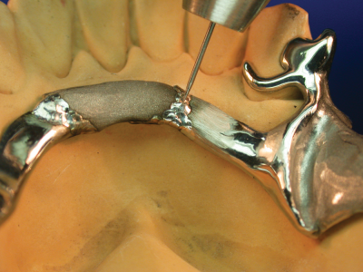repair of broken sublingual bar
