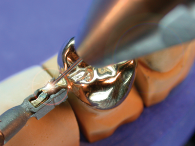 secondary crown to partial