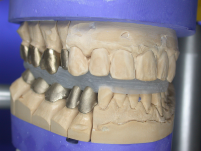 primosplint - verification index in occlusion