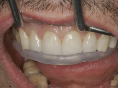 primosplint - insertion guide in situ