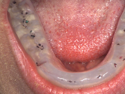 primosplint - bite splint in situ