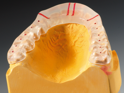 primosplint - function-therapy bite splint